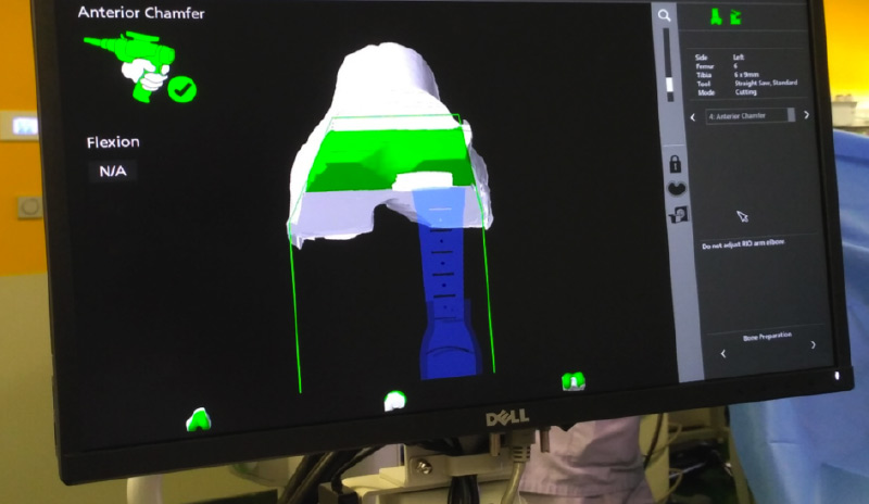 Le robot Mako leader de la chirurgie robotique en orthopédie - CHROMA  Marseille chirurgie orthopédique robotique Marseille